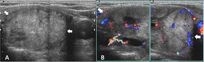 Unexpected Lung and Brain Metastases 9 Years After Thyroid Lobectomy for Follicular Adenoma: A Case Report